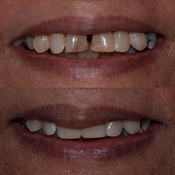 Before and After Gallery Photo