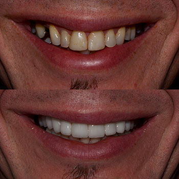 Before and After Gallery Photo