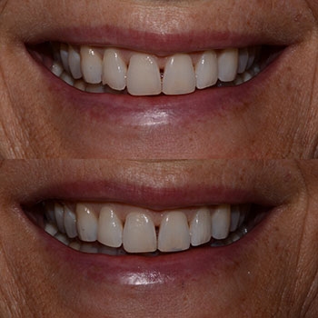 Before and After Gallery Photo