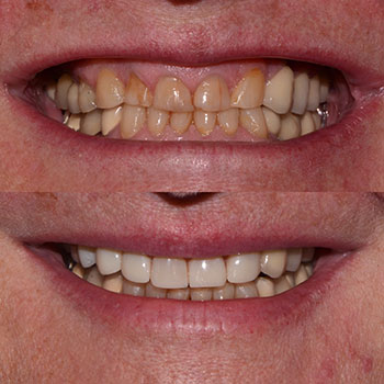 Before and After Gallery Photo