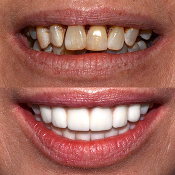 Before and After Gallery Photo