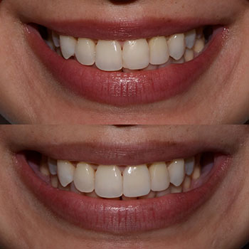 Before and After Gallery Photo