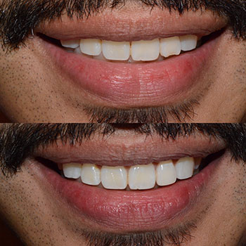 Before and After Gallery Photo