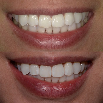 Before and After Gallery Photo