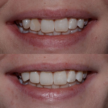 Before and After Gallery Photo