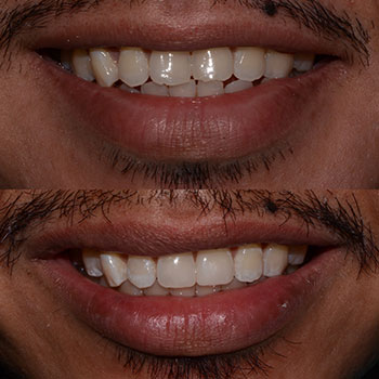 Before and After Gallery Photo
