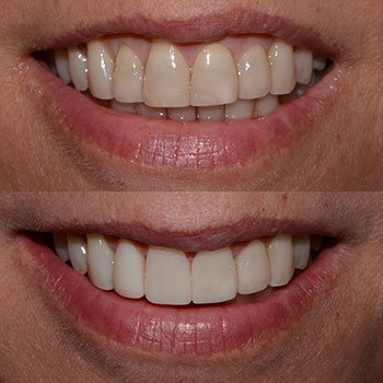 Before and After Gallery Photo