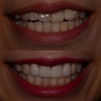 Cosmetic veneers