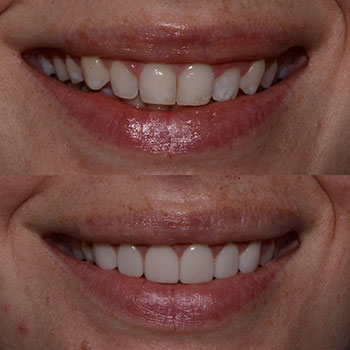 Cosmetic veneers