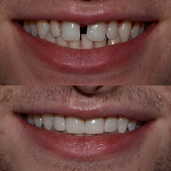 Invisalign with upper anterior cosmetic bonding