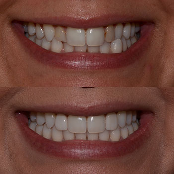 Invisalign with lateral veneers