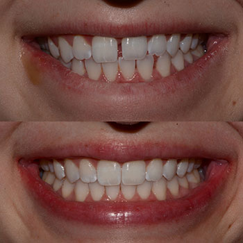 Invisalign with cosmetic recontouring