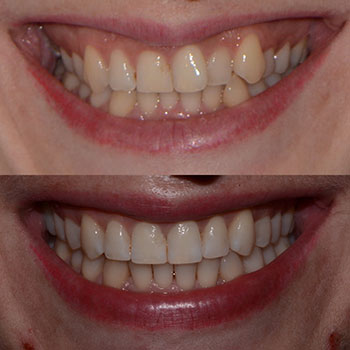 Invisalign with cosmetic recontouring