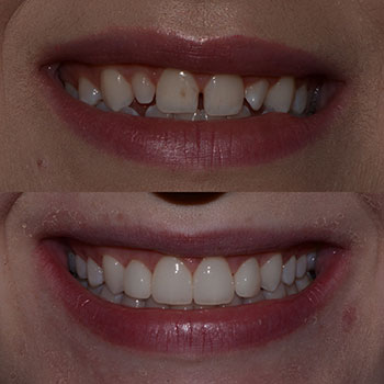 Invisalign with lateral minimum prep veneers