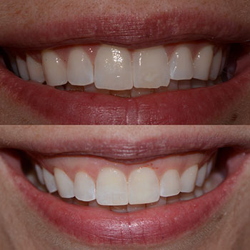 Anterior cosmetic bonding with recontouring