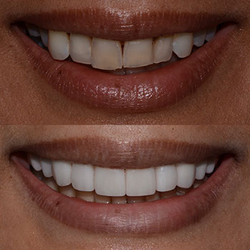 Cosmetic crowns and veneers