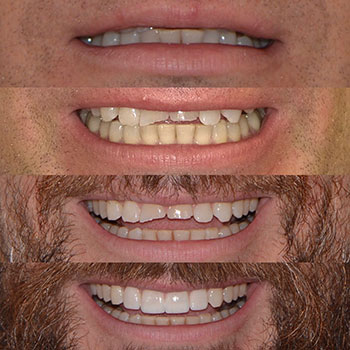 Invisalign, cosmetic crowns, veneers and recontouring