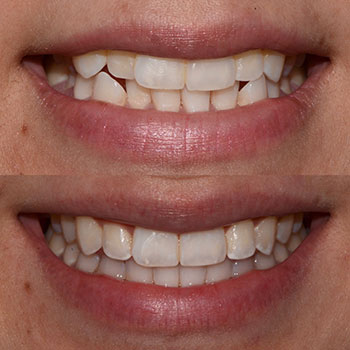 Invisalign with cosmetic recontouring