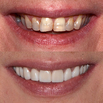 Cosmetic veneers, posterior implants and bridge to replace missing teeth