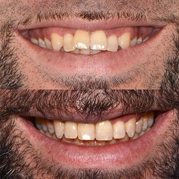 Invisalign with cosmetic recontouring