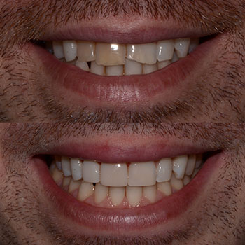 Cosmetic bonding for shade correction and repair fractured tooth