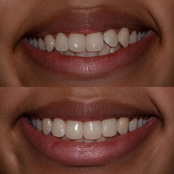 Invisalign with lateral cosmetic bonding