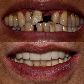 Periodontal therapy, occlusal equilibration, dental implants, bridge with cosmetic recontouring