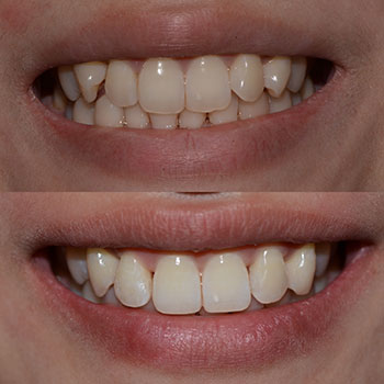 Invisalign with cosmetic recontouring