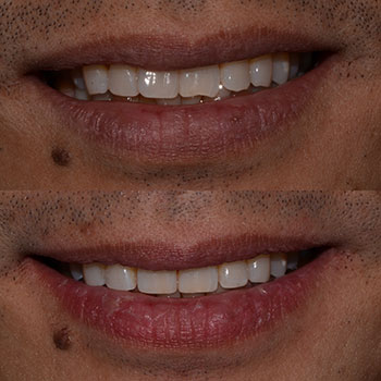 Invisalign with cosmetic recontouring