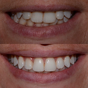 Invisalign with recontouring