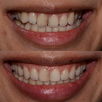 Invisalign with Cosmetic recontouring