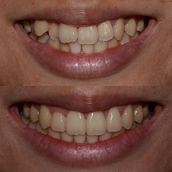 Invisalign with cosmetic recontouring