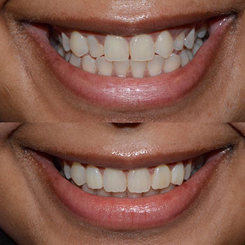 Crown lengthening with cosmetic bonding