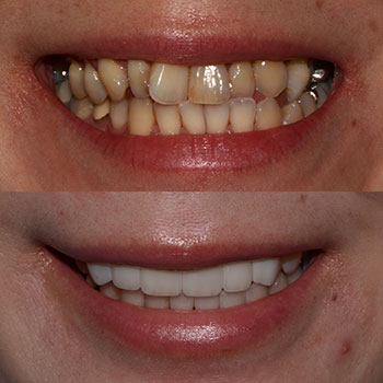 Invisalign, cosmetic veneers and recontouring