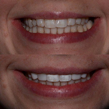 Invisalign with cosmetic bonding and recontouring