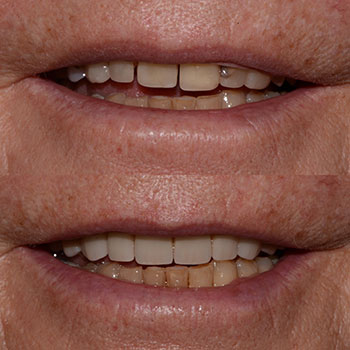 Upper arch reconstruction with ceramic restorations