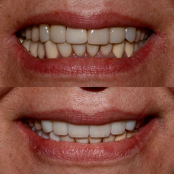 Anterior ceramic restorations and cosmetic bonding