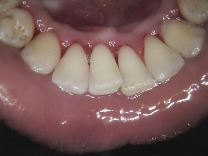 Teeth Cleaning Before And After TeethWalls