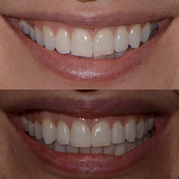 Invisalign with cosmetic bonding