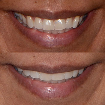 Invisalign with cosmetic recontouring