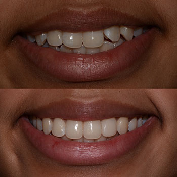 Invisalign with cosmetic bonding and recontouring