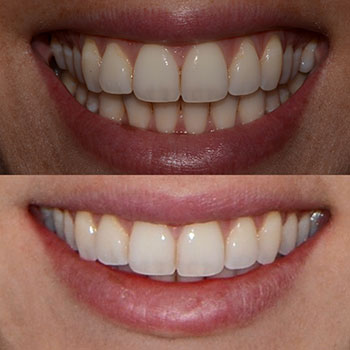 Invisalign with cosmetic bonding