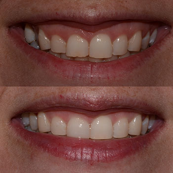 Invisalign with cosmetic bonding and recontouring