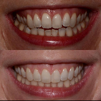 Invisalign with cosmetic recontouring