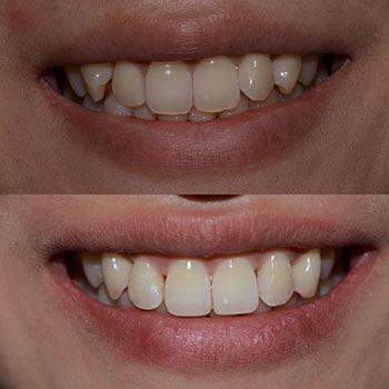 Invisalign with cosmetic recontouring