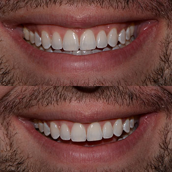 Invisalign with cosmetic recontouring