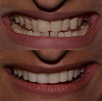 Invisalign with cosmetic bonding and recontouring