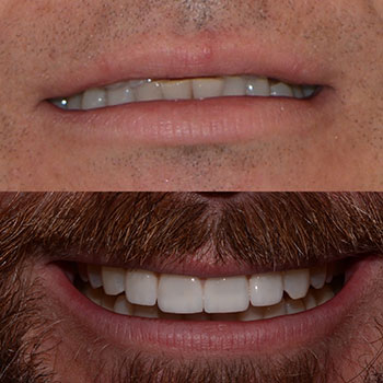 Invisalign, cosmetic veneers