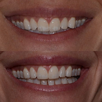 Invisalign and cosmetic recontouring