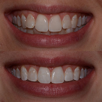 Invisalign with cosmetic recontouring